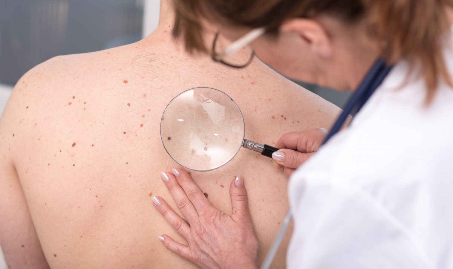 Skin Cancer checks